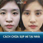 XEM NGAY 6 cách chữa sụp mí tại nhà, hồi xuân cho đôi mắt!