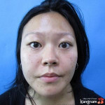 BVTM Kangnam giải cứu đôi mắt sụp mí suốt 28 năm của chị Trần Mai Ngọc