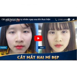 Video khách hàng cắt mí mắt tại BVTM Kangnam và cảm nhận của mỗi người
