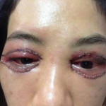[TIN VUI] Cắt mí mắt bị hỏng hoàn toàn khắc phục được chỉ sau 1 ngày