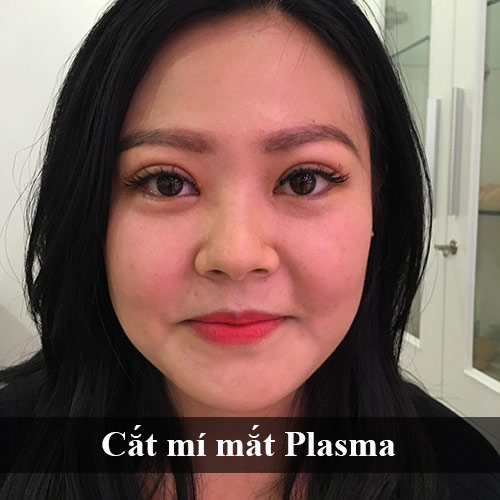 Cắt mí mắt Plasma là gì? Nên hay Không? Quy trình phẫu thuật?