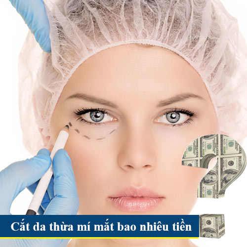 cắt da thừa mí mắt bao nhiêu tiền? 1