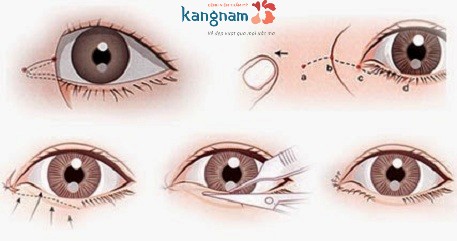cắt khóe mắt