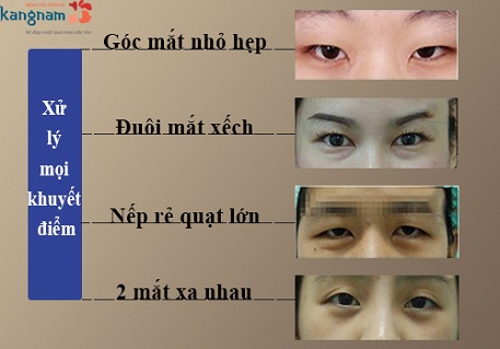phẫu thuật cắt khóe mắt