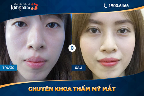 chuyên khoa thẩm mỹ mắt bệnh viện thẩm mỹ kangnam 3