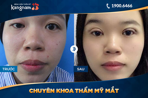 chuyên khoa thẩm mỹ mắt bệnh viện thẩm mỹ kangnam 2