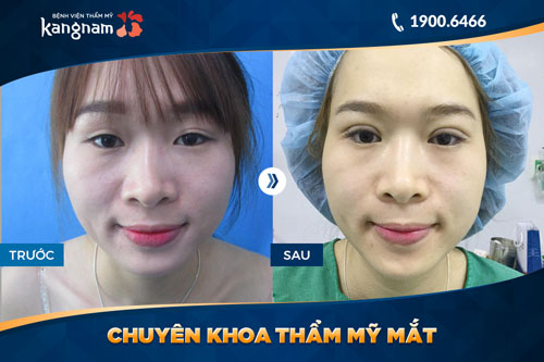 chuyên khoa thẩm mỹ mắt bệnh viện thẩm mỹ kangnam 7