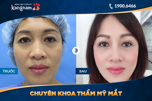 chuyên khoa thẩm mỹ mắt bệnh viện thẩm mỹ kangnam 8