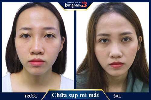Sụp mí là gì? Cách chữa sụp mí mắt hiệu quả sau 1 lần thực hiện1