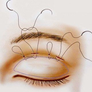 Nhấn mí có nguy hiểm không? 3 Điều bạn nên biết trước khi bấm mí