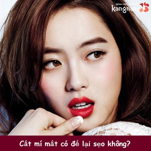 Cắt mí mắt có để lại sẹo không? Nguyên nhân sẹo xuất hiện sau cắt mí