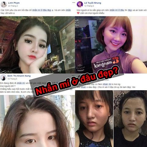 Nhấn mí ở đâu đẹp? Mách bạn 3 bước tìm địa chỉ nhấn mí đẹp và an toàn