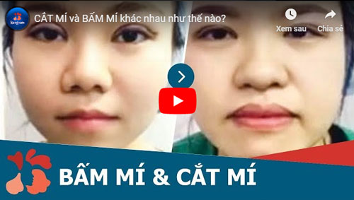 VIDEO So sánh cắt mí và bấm mí mắt tại Kangnam