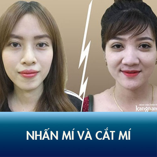 Cắt mí và bấm mí khác nhau như thế nào? AI nên nhấn mí? AI nên cắt mí mắt?