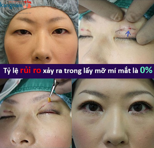  bóc mỡ mắt có nguy hiểm không