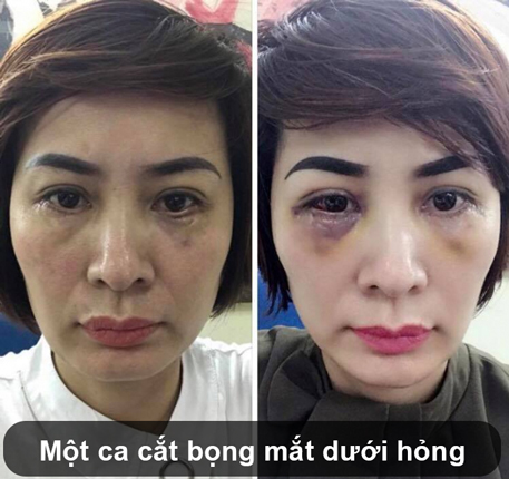 Cắt bọng mắt ở đâu