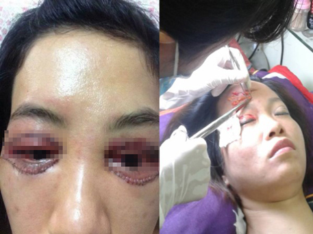 cắt bọng mắt dưới ở đâu đẹp