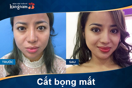 phẫu thuật cắt bọng mắt ở đâu uy tín