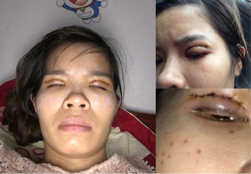 cắt mí mắt có để lại di chứng gì không