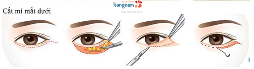 cắt mí mắt dưới có hại không