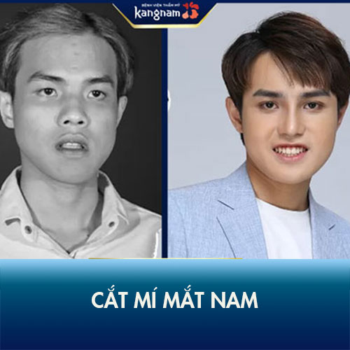 Cắt mí mắt nam – Những điều phái mạnh cần biết trước khi cắt mí nam