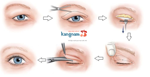 cắt mỡ mí mắt có nguy hiểm không 2