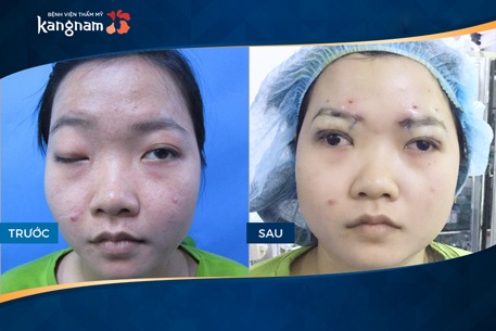 Đi tìm lời giải đáp: “Chữa sụp mí mắt ở đâu tốt và an toàn nhất hiện nay?”