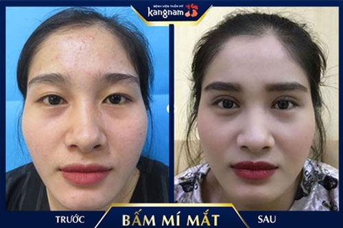 mắt một mí rưỡi