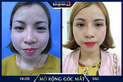 mở góc mắt ở đâu đẹp