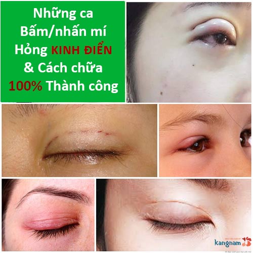 Những ca nhấn mí bị hỏng và cách chữa nhấn mí hỏng thành công 99,99%