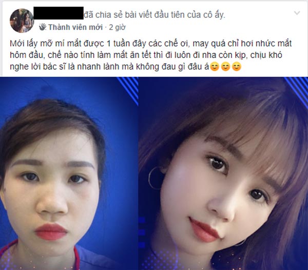 bóc mỡ mí mắt có đau không 1