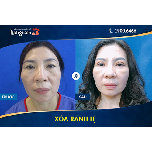 (Rãnh mắt)Rãnh lệ là gì? Chi phí xóa rãnh lệ bao nhiêu tiền? Có đắt không?
