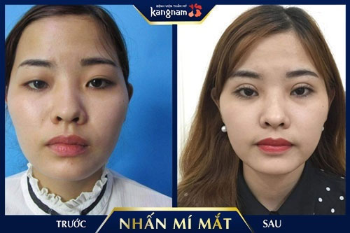 nhấn mí cần kiêng ăn gì 