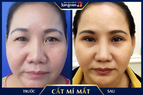 nên cắt mí mắt ở đâu 