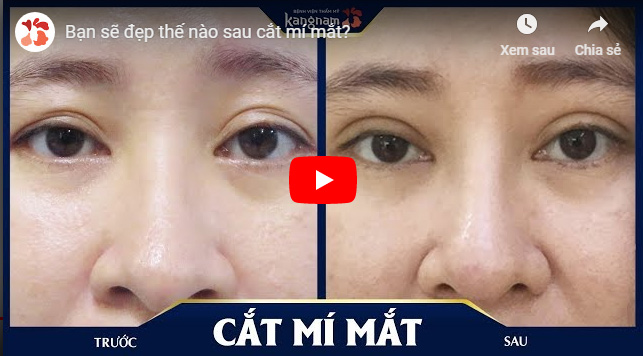 Video cắt mí mắt ở đâu đẹp