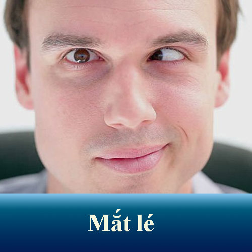 Mắt lé là gì? Mắt lác có chữa được không? Cách chữa lác mắt ở mọi độ tuổi.