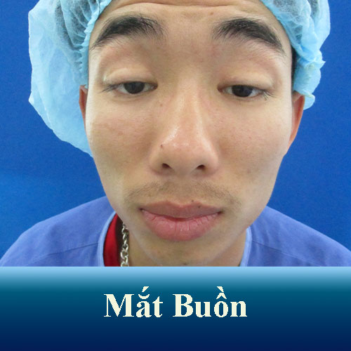 Mắt lờ đờ/Mắt buồn là mắt như thế nào? Cách khắc phục mắt lờ đờ buồn ngủ
