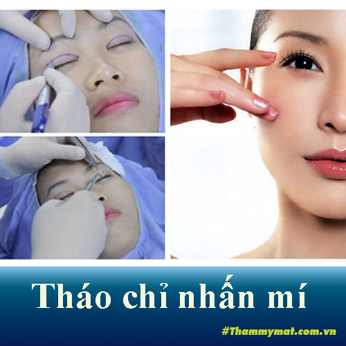 Tháo chỉ nhấn mí bao lâu thì lành? Tháo nhấn mí có đau không? Giá tháo ra sao?