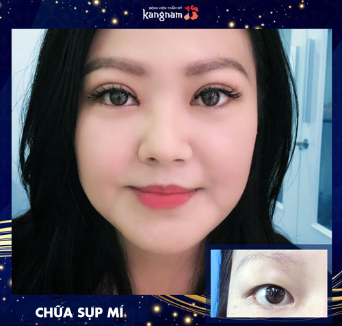 Sụp mí mắt là gì? Biểu hiện, nguyên nhân và cách chữa trị HIỆU QUẢ NHẤT