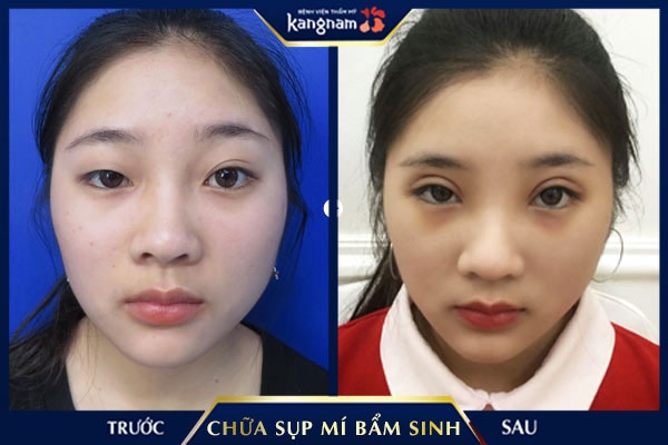 chữa mắt sụp mí tại Bệnh viện Thẩm mỹ Kangnam