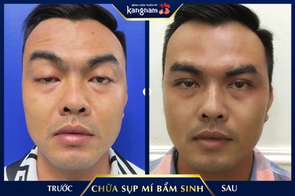 chữa sụp mí bẩm sinh