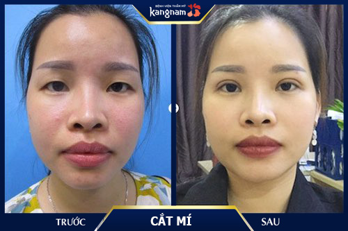 đeo kính cận mắt bị sụp mí