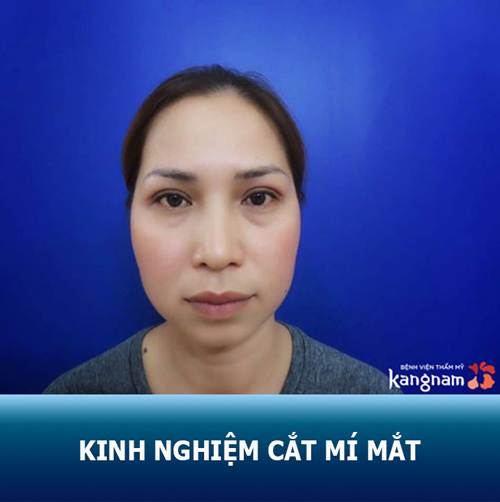 Từ A – Z kinh nghiệm cắt mí mắt an toàn – hồi phục nhanh chóng – hiệu quả lâu dài
