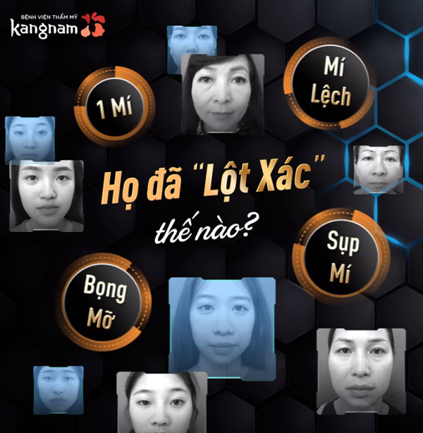 Top 7+ Các ca cắt mí mắt đẹp – Những “siêu phẩm” để đời