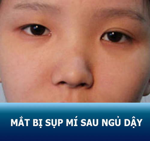Mắt bị sụp mí sau khi ngủ dậy: Nguyên nhân và cách khắc phục dứt điểm